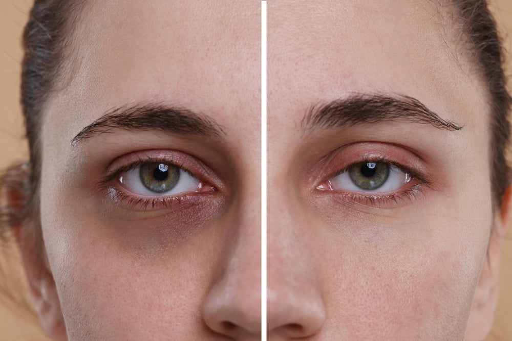Combat Puffiness and Dark Circles: Restore Bright, Radiant Eyes
